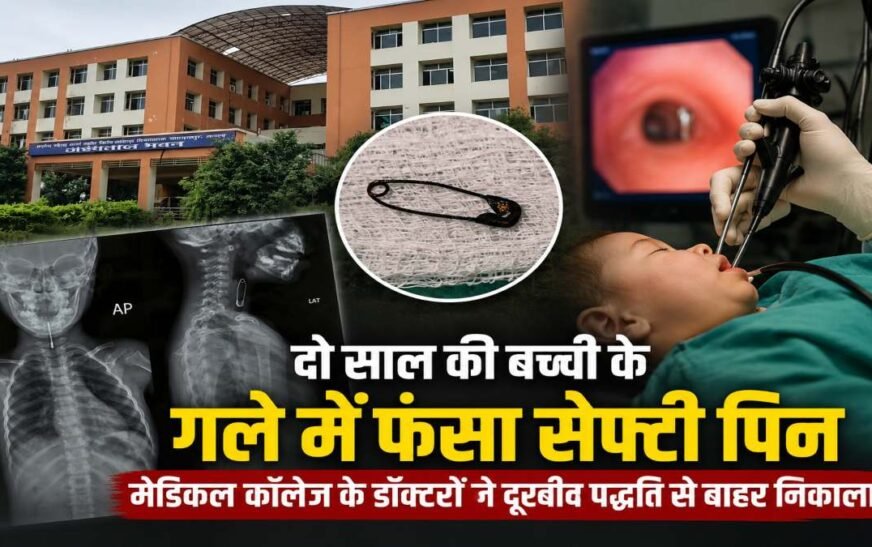दो साल की बच्ची के गले में फंसा सेफ्टी पिन, डॉक्टरों ने दूरबीन पद्धति से निकालकर बचाई जान